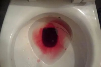 ​医生，昨晚吃火龙果后尿变红色，怎么办？