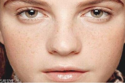 ​大蒜祛斑真的有用吗 大蒜祛斑的准确步骤