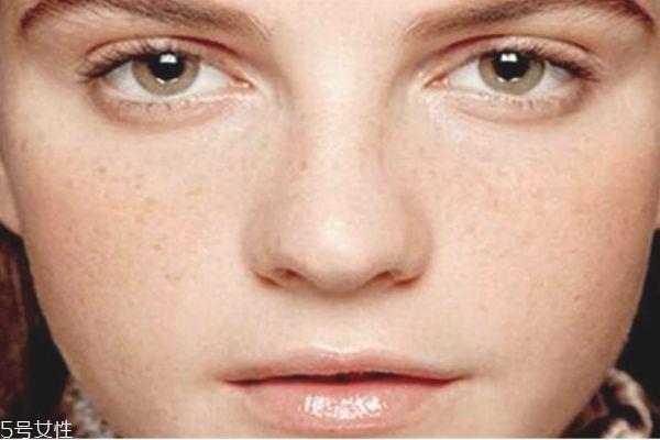 大蒜祛斑真的有用吗 大蒜祛斑的准确步骤 大蒜祛斑真的有用吗 大蒜祛斑的准确步骤