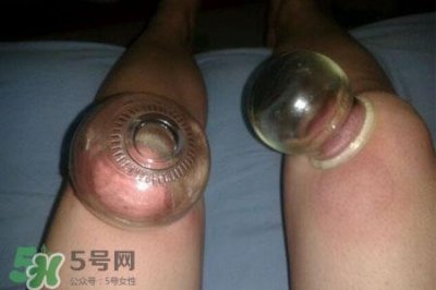 ​小腿能拔罐吗？在小腿上拔火罐有什么作用？