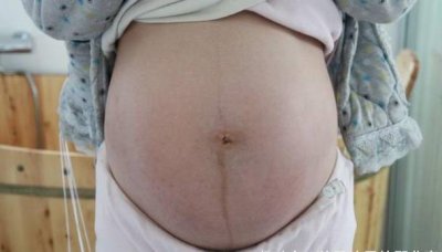 ​怀孕期间，孕妈若有3个感觉，可能马上“长妊娠纹”，不妨一看