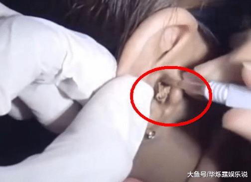 女子10年没挖耳屎, 突然奇痒无比, 结果挖出的东西让人大开眼界