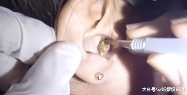 女子10年没挖耳屎, 突然奇痒无比, 结果挖出的东西让人大开眼界