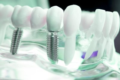 ​日本将停止种植牙？注意！这4类人不建议种！5种危害要知道