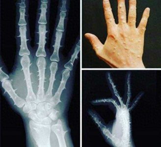 ​罕见的骨膜炎