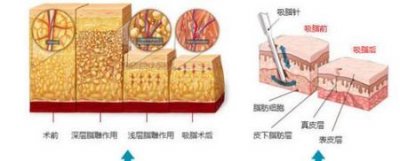 ​面部吸脂多久能达到最佳效果(面部吸脂后要多久才能达到最佳效果?)