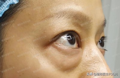 ​42岁女士来北京做了外切祛眼袋，术后恢复到3个月，高清过程照片