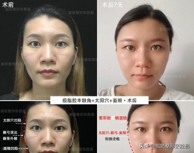 ​一块骨头把温柔脸变凶脸？她颧骨高如山，不经磨骨之痛却收获了美