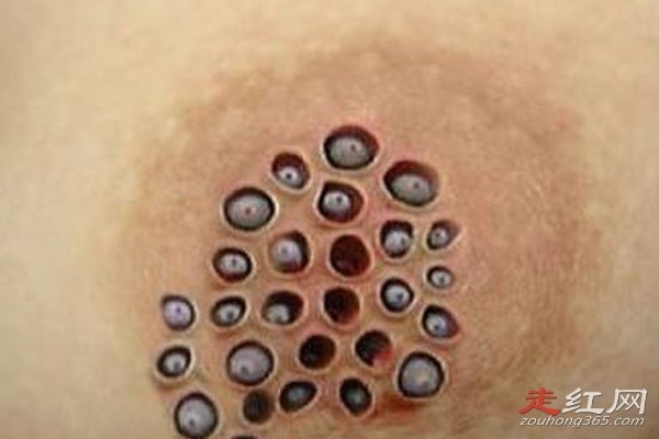 空手指莲蓬乳芝麻女是怎么回事 密集恐惧症的人看到会晕倒