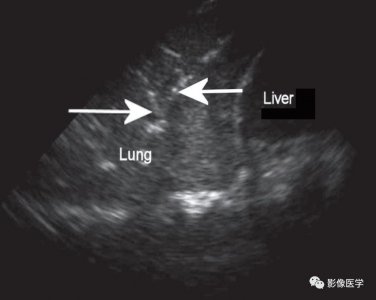 ​新生儿肺炎的超声诊断 （附典型图像）