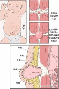 ​一些新手妈妈，关于宝宝的脐疝，您了解多少